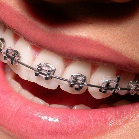 Sonrisa con brackets metálicos
