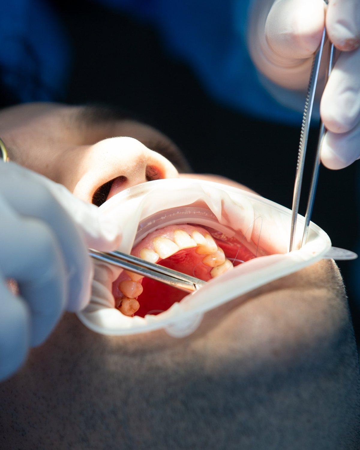 Procedimiento dental con separador bucal