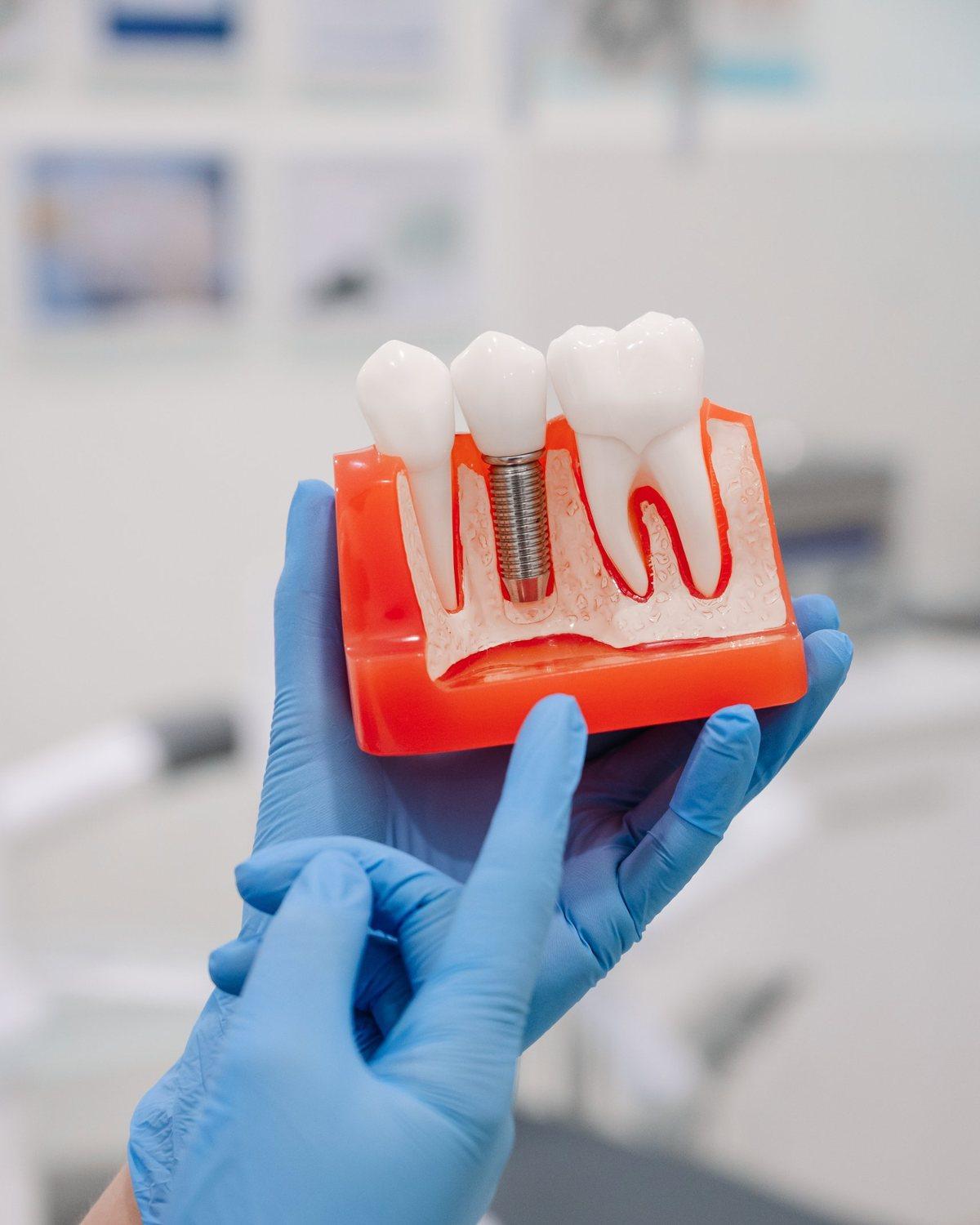 Modelo de implante dental con corona sobre encía