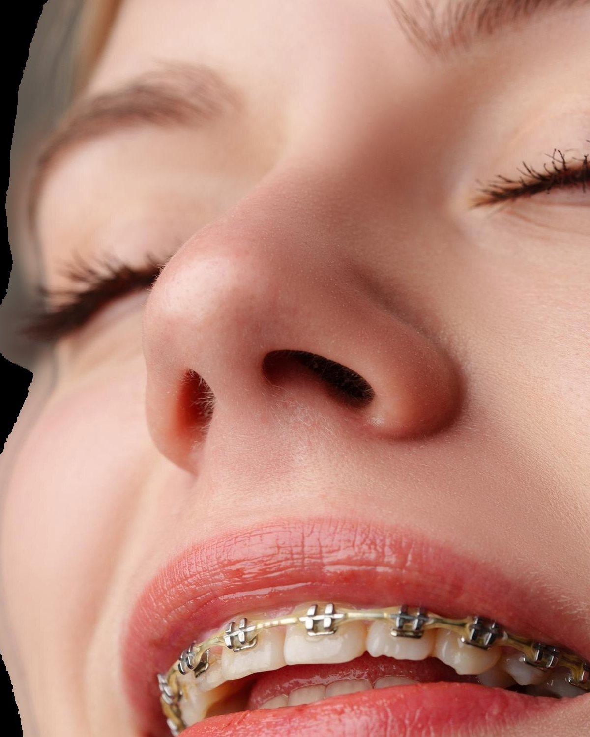 Primer plano de una sonrisa con brackets